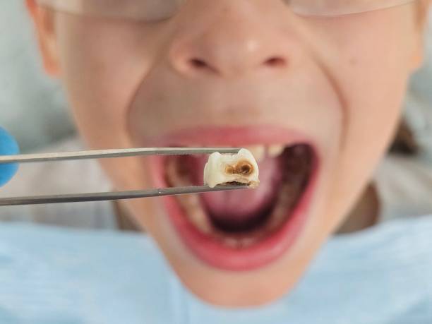Best Emergency Treatment for Dental Infections or Abscesses in Harris Hill, NY